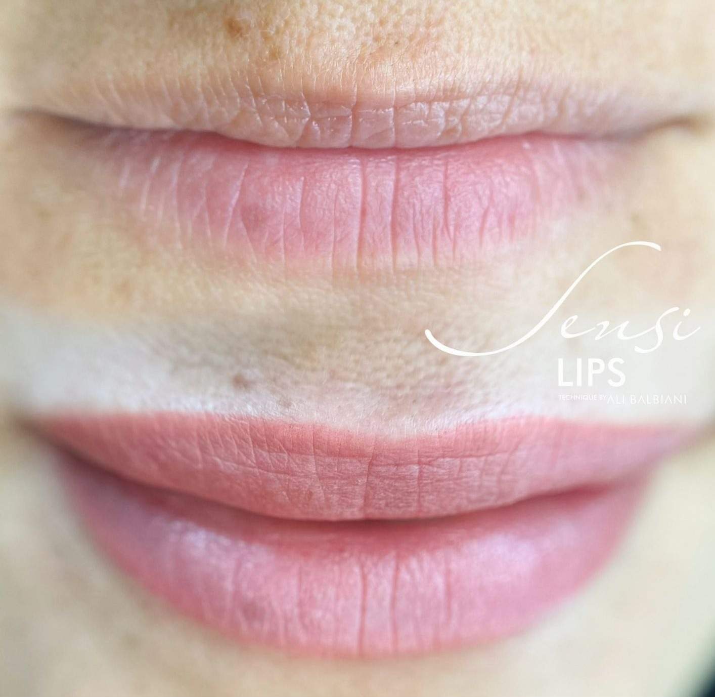 Resultado Sensi Lips®